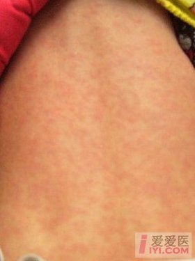 小儿各类皮疹及图片