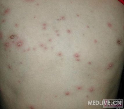 小儿各类皮疹及图片