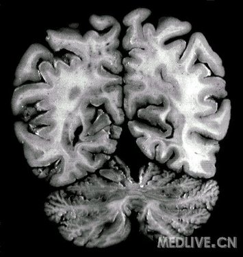 发一组漂亮的脑冠状切面图