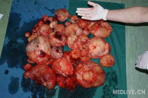 让人震撼的粘液性脂肪肉瘤