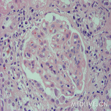 【讨论】认识肾穿刺病理_圈子_医脉通