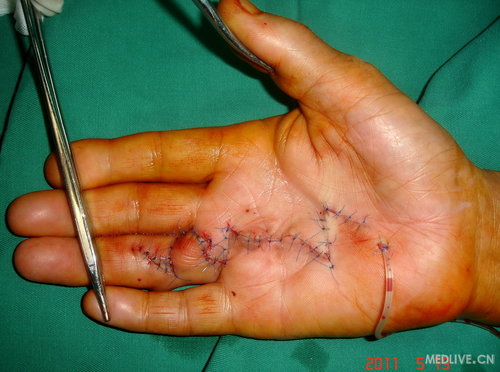 掌腱膜挛缩请讨论手术切口设计