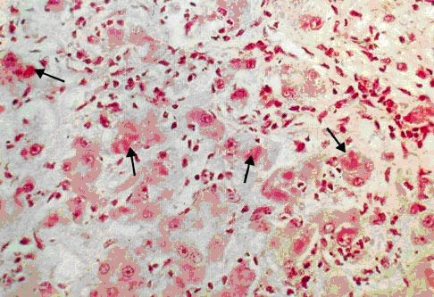 图3:酒精性肝炎,箭头所指为mallory小体图4:酒精性肝纤维化编写者