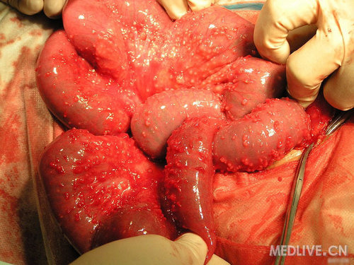 取束带组织,肠系膜根部结节,大网膜组织送活检,病理未归.