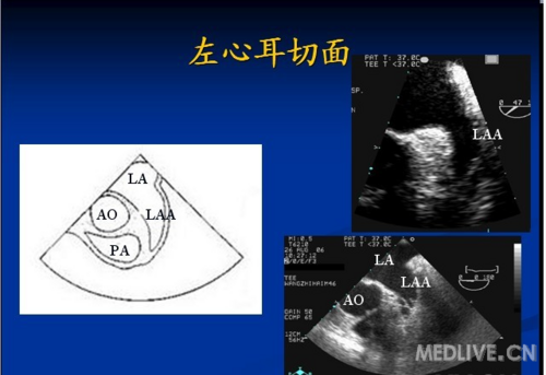 经食道超声心动图----常用标准切面_圈子_医脉通