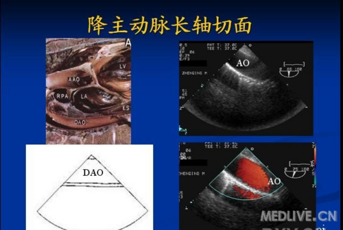 经食道超声心动图常用标准切面