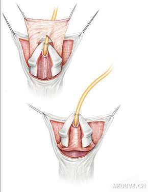 a dartos pedicle flap is dissected from thepreputial hood and