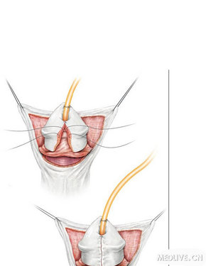 尿道下裂tip手术图解snodgrasstechniqueforhypospadiasrepair