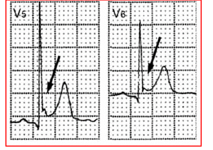 早期复极综合征心电图图片