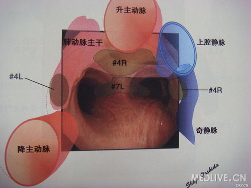 气管镜下的气管解剖图图片