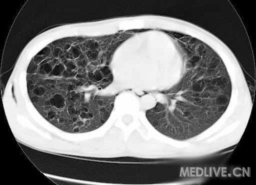 病例讨论非常病例肺囊肿自发性气胸