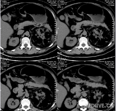 女性盆腔静脉石图片