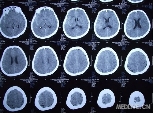 资源蛛网膜下腔出血各种图片