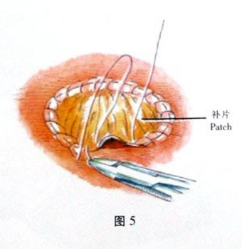 房间隔缺损修补术示意图