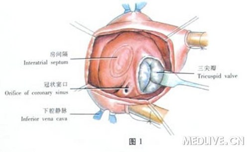 资源室间隔缺损修补术彩色示意图