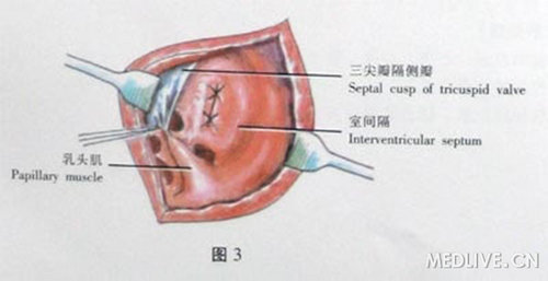 室间隔缺损修补术彩色示意图