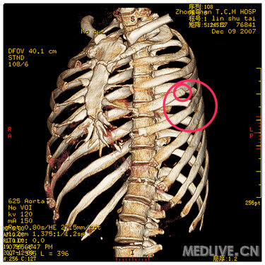 诊断为左侧第4肋骨后段及第4