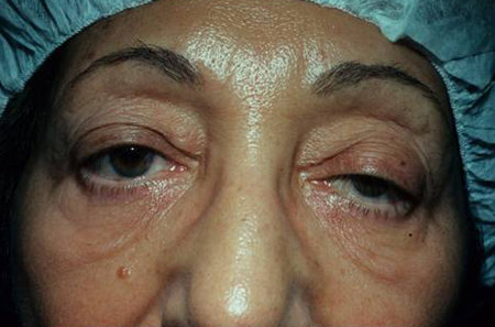 霍纳综合征四大症状