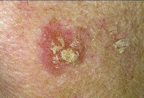 看图识病各种皮肤癌及癌前病变的不同表现