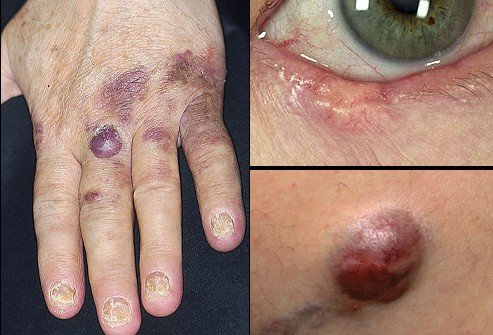 皮肤癌前兆图片