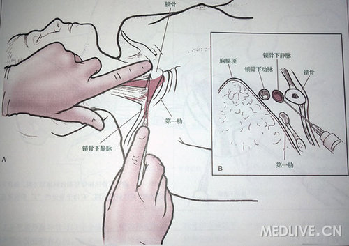 中心静脉穿刺演示附图