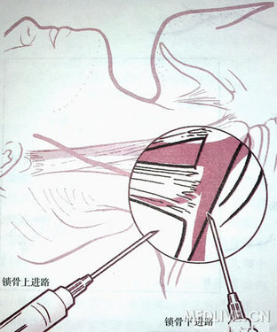 中心静脉穿刺演示附图