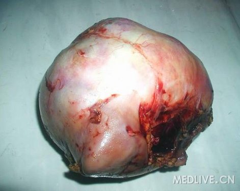 图片肾透明细胞癌