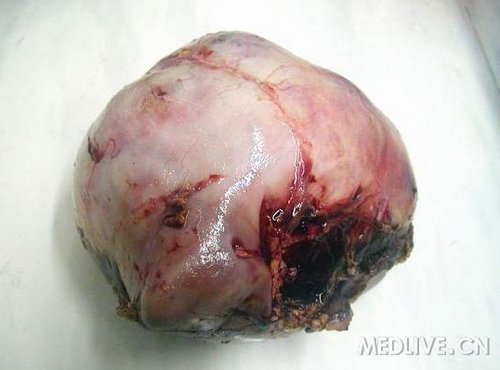 图片肾透明细胞癌