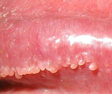 病例讨论阴茎珍珠样丘疹