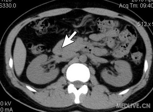 环形胰腺你知道多少