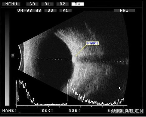 结合病例学习视盘玻璃膜疣的影像学表现