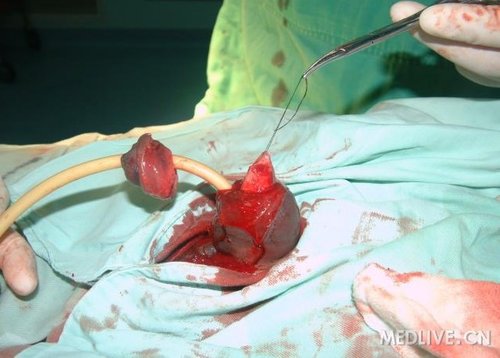 病例阴茎被咬掉再植术图