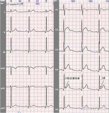急性心包炎的心电图表现