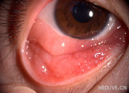 行病理检查:见双眼下睑结膜铺路石样乳头增生,穹窿结膜形似结膜松弛样