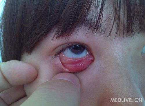 行病理检查:见双眼下睑结膜铺路石样乳头增生,穹窿结膜形似结膜松弛样