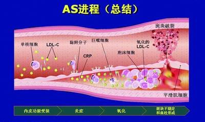 动脉粥样硬化发生机制研究新进展