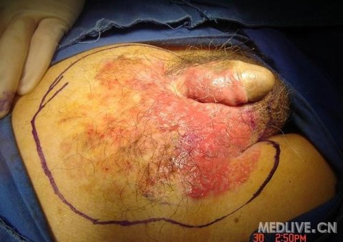 看到了一例特色手术阴囊paget病灶切除皮瓣转移术