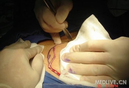 看到了一例特色手术阴囊paget病灶切除皮瓣转移术