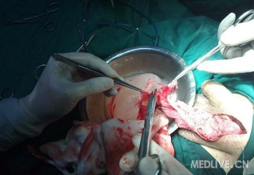 病例大不大附睾囊肿1例