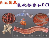 再次聚焦氯吡格雷和PCI