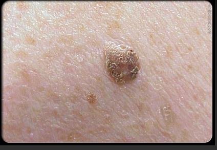 日光照射的头部,颈部,手臂,下肢,但也会蔓延至身体其他部位;皮脂腺癌