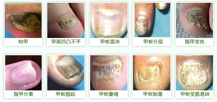 各种甲癣症状图片
