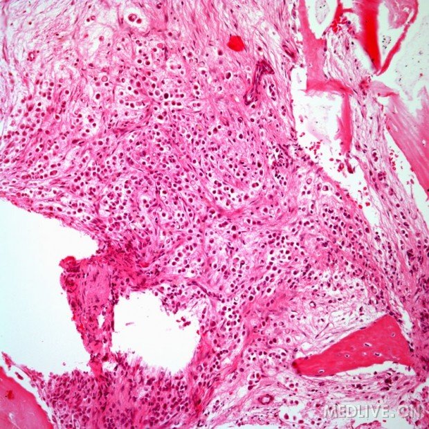 图4  高的放大倍数示转移性癌从乳腺癌组织到骨髓higher