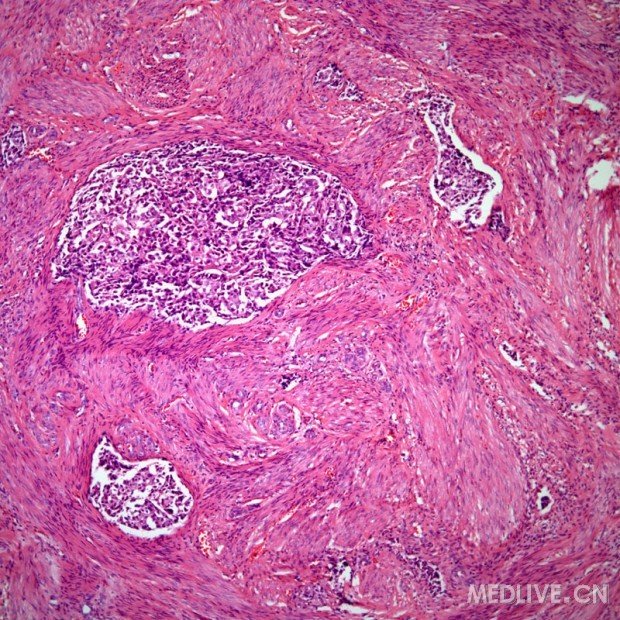 图片转移性乳腺癌病理学图片