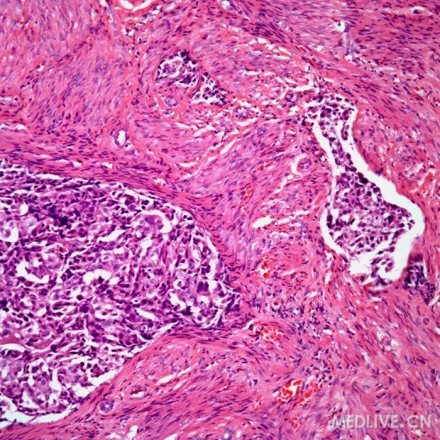图片转移性乳腺癌病理学图片