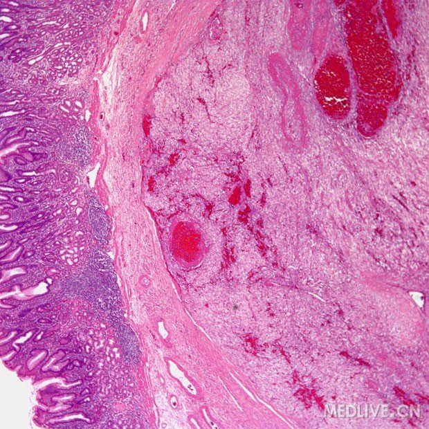 胃癌病理图片