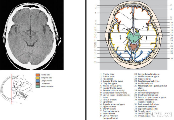 收藏颅脑ct对照图谱