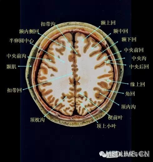 外侧面上相当于侧脑室体部前端水平外找到,其前后脑回分别为中央前,后