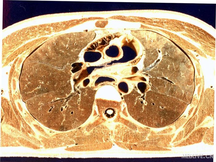 肺门和肺段断层解剖及ct