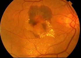 抗PDGF联合抗VEGF治疗湿性AMD